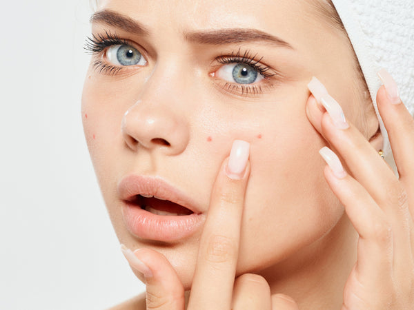 Header_Guide To Getting Rid Of Acne