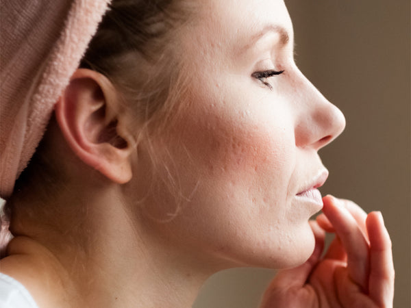 Header_How to get rid of acne scars