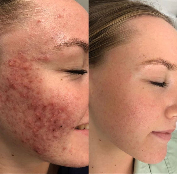 girl using serum's before and after