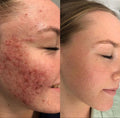 girl using serum's before and after